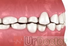 صرير الأسنانBruxism