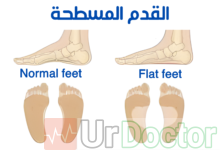 القدم المسطحة