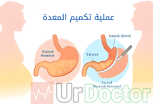 عملية تكميم المعدة