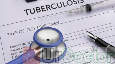 Tuberculosis test G 1177638025